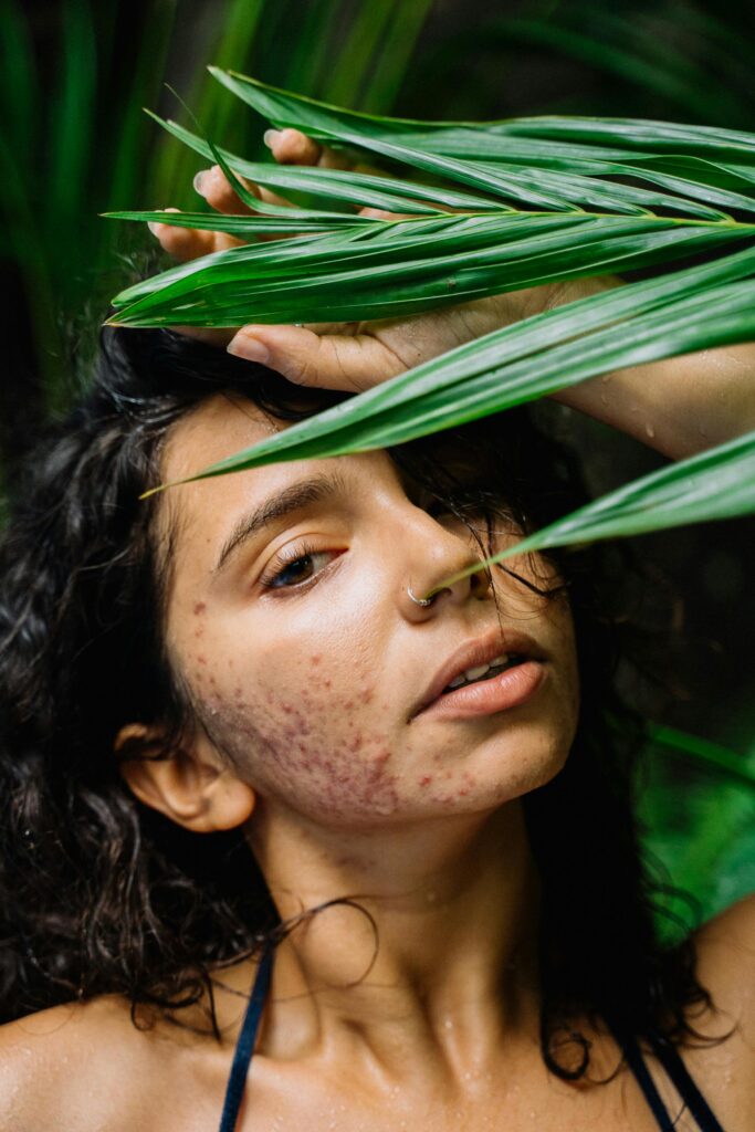 Close-up of a woman with acne and nose piercing surrounded by lush green leaves in a tropical environment.
